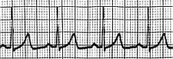 ecg paper trace