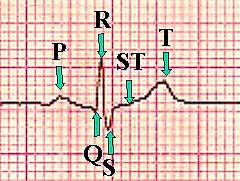 ecg pqrst waveform