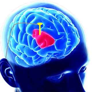 Deep Brain stimulation for Parkinson's
