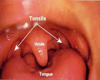 tonsillectomy with harmonic scalpel