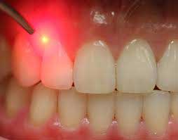 PTT dental therapy