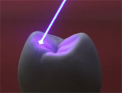 tooth laser