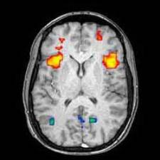 Functional Magnetic Resonance Imaging [fMRI]