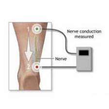 Nerve Conduction Velocity (NCV) Test